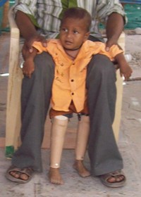 StandingtallwithhisJaipurfoot