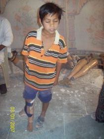 StandingtallwithhisJaipurfoot