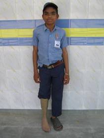ChildwithJaipurFoot