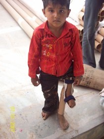 StandingtallwithhisJaipurfoot