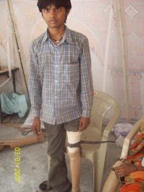 StandingtallwithhisJaipurfoot