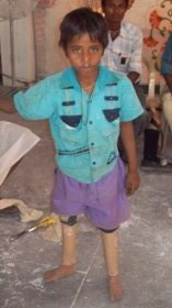 StandingtallwithhisJaipurfoot