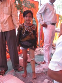 StandingtallwithherJaipurfoot