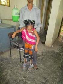 ChildwithJaipurFoot