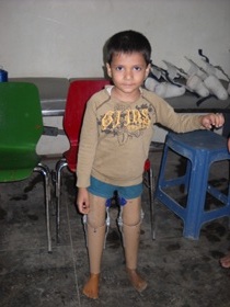 ChildwithJaipurFoot